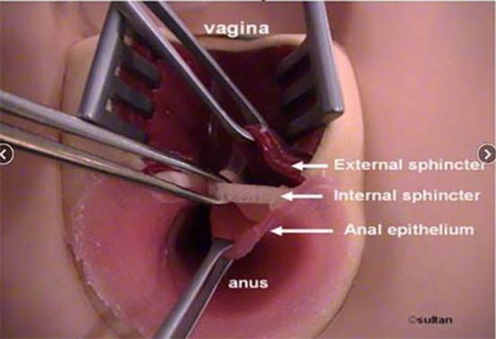 Anal Sphincter Repair 9